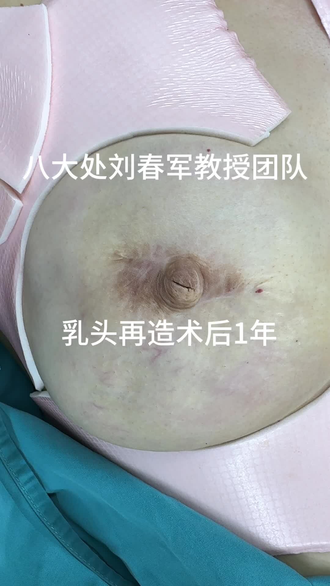 乳腺癌切除后乳房再造,乳头再造