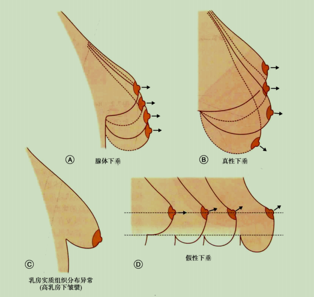 乳房下垂类型png