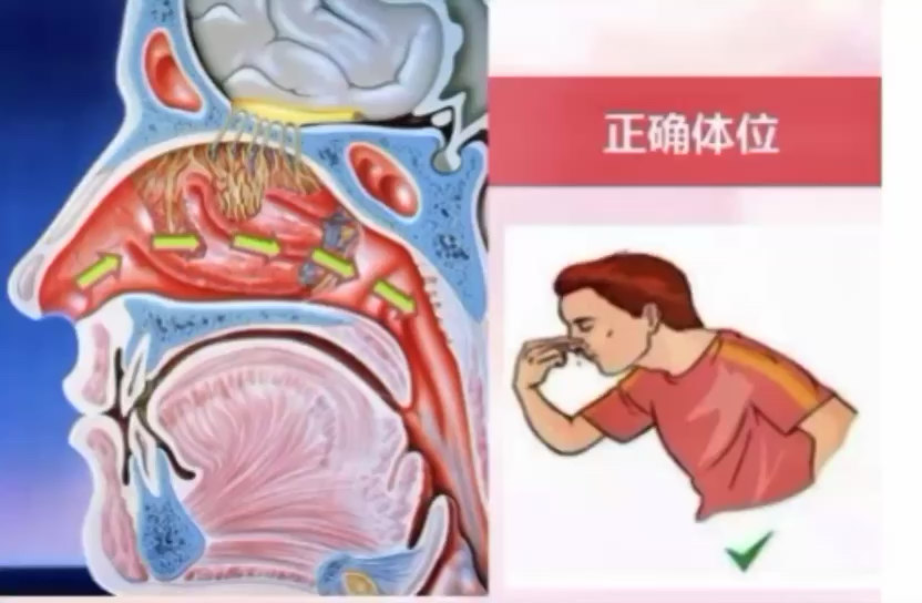 鼻出血的正确自我止血方法