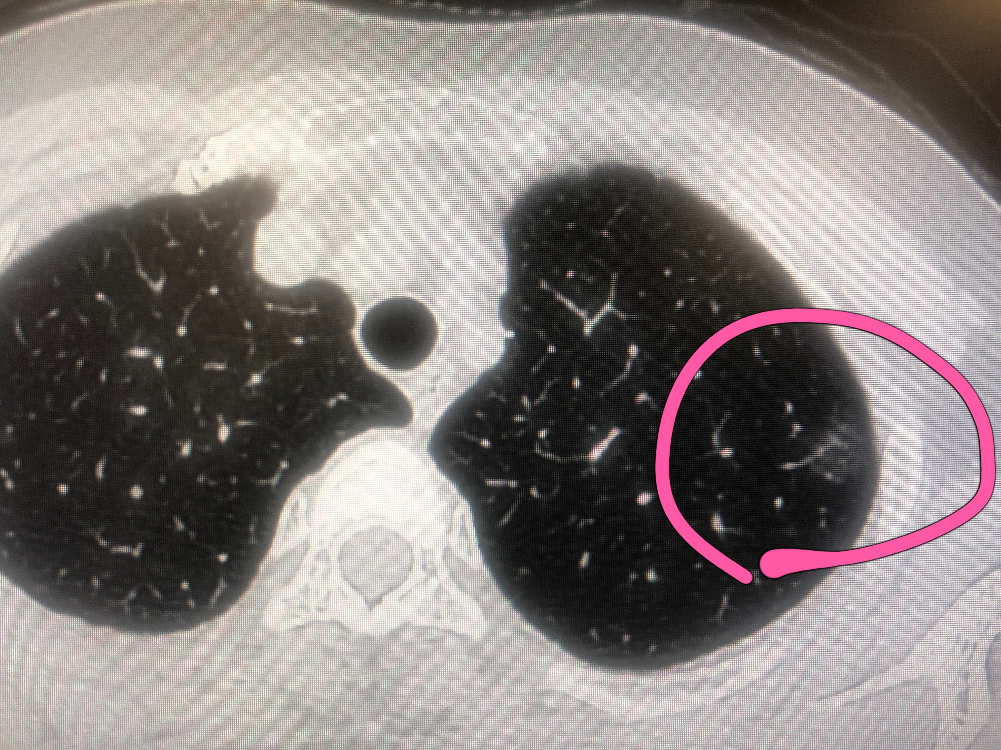 磨玻璃结节 磨玻璃结节