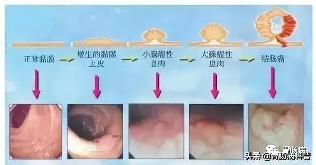 直肠菜花状肿瘤图片图片