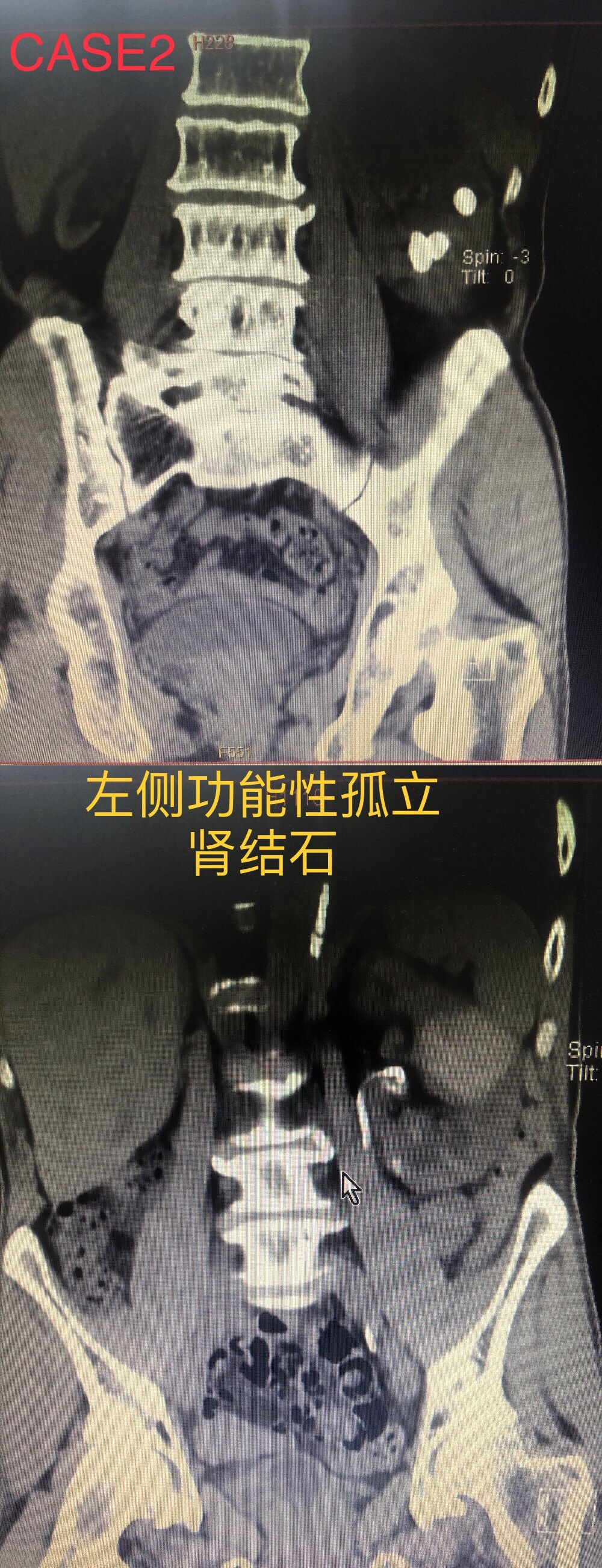 感染等具體情況,選擇個體化的治療方案,如:膀胱鏡下雙j管置管引流,經