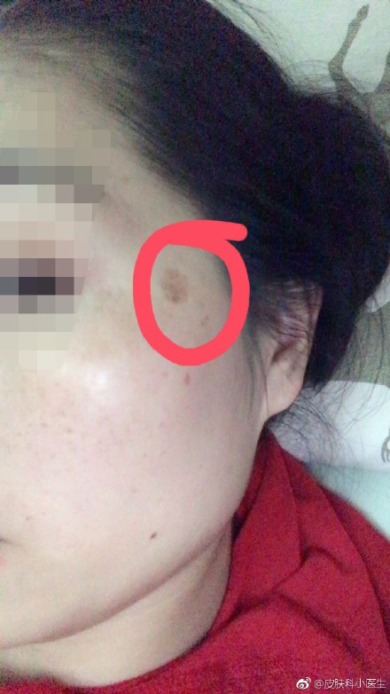 宝妈问太阳穴部位是什么斑?_老年斑_介绍_如何预防 - 好大夫在线