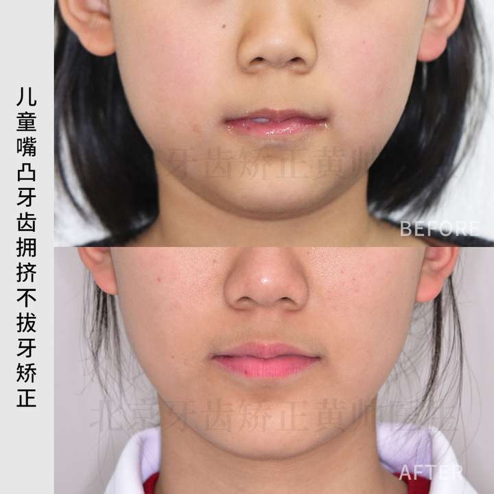 儿童牙齿拥挤不拔牙,不片切,不打骨钉,还不能嘴凸?案例分享!