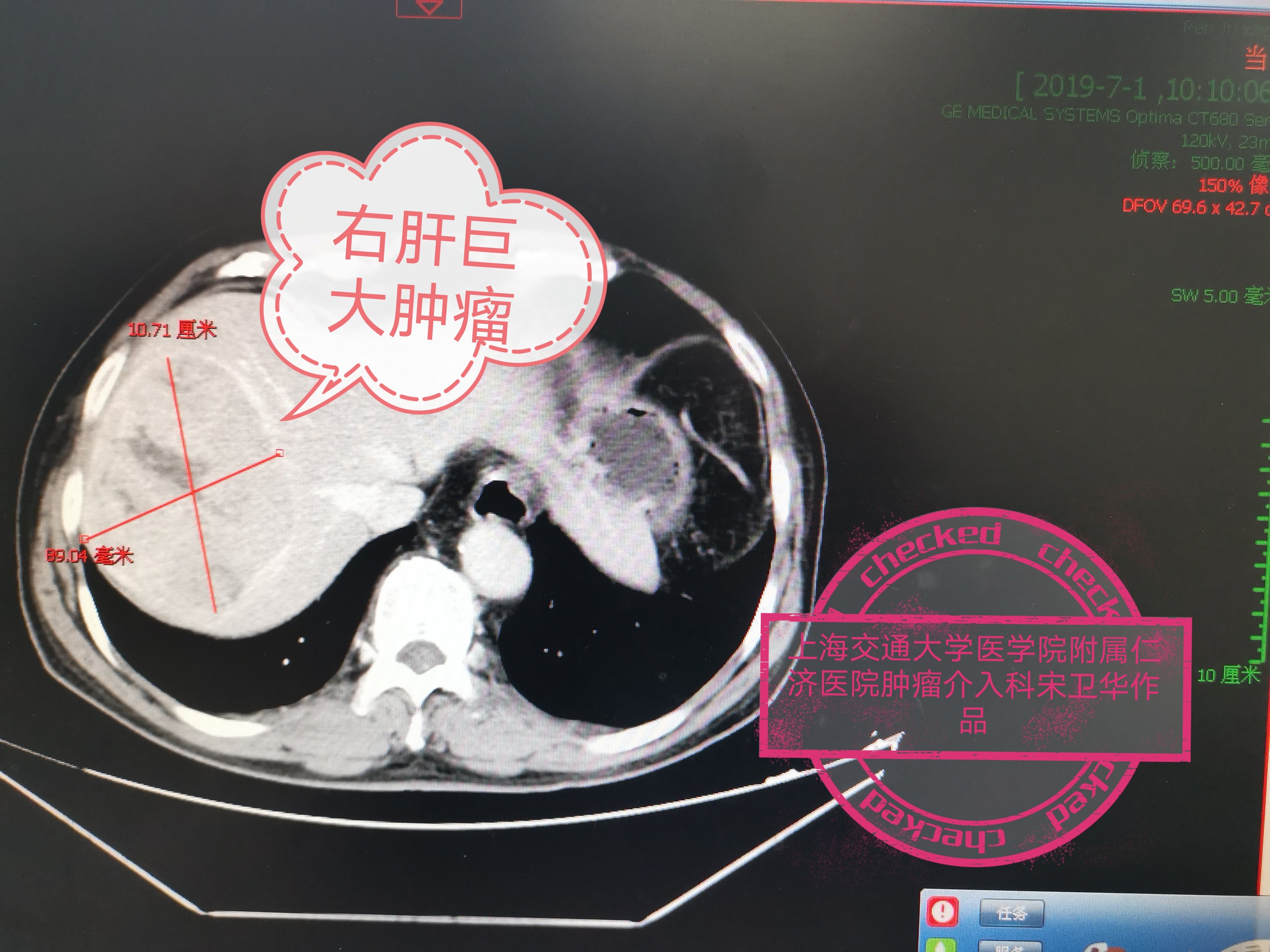 巨块型肝癌介入治疗后肿瘤完全坏死 好大夫在线