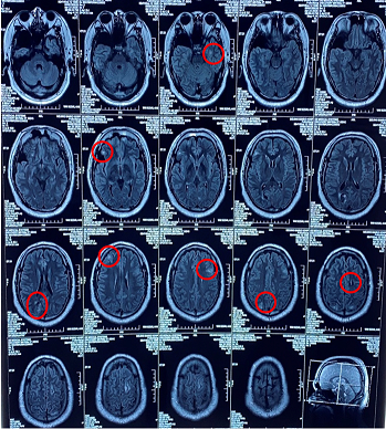 脑结节性硬化症状图片图片