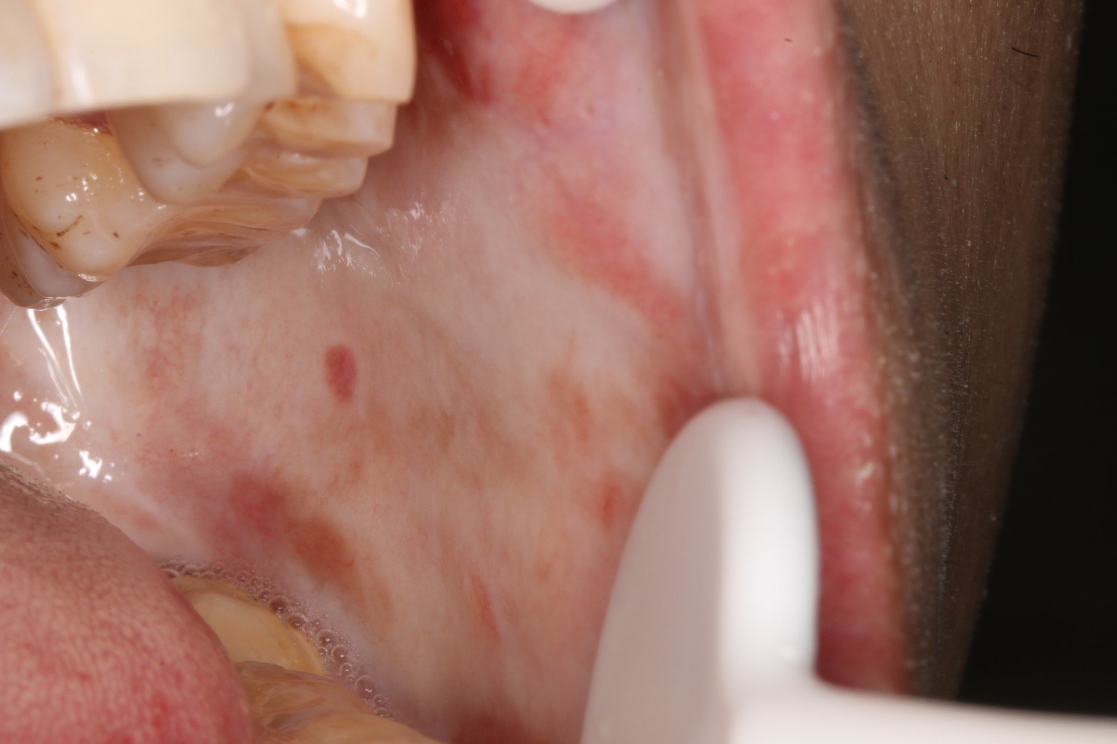 osf患者的一般临床表现是口腔黏膜的大片均质状白色病变,以颊粘膜最为