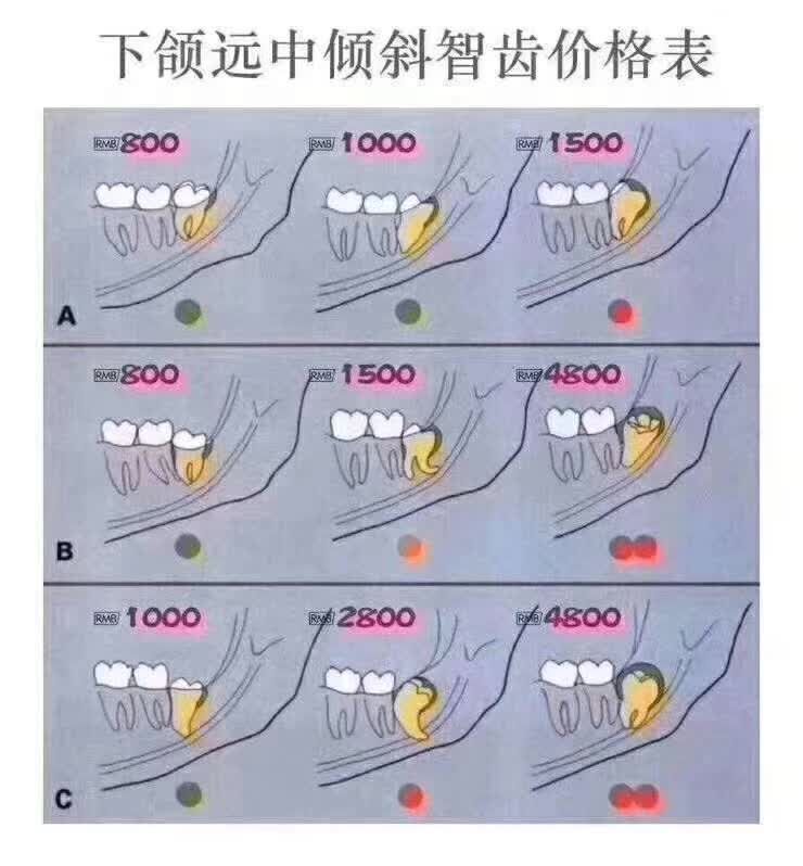 為啥拔智齒收費差別這麼大看了這3張圖你就明白了