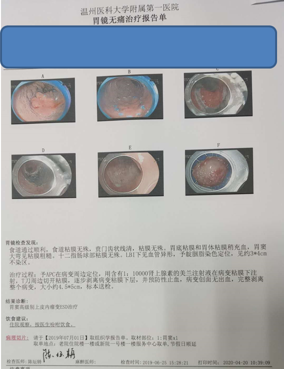 早期胃癌胃高级别上皮内瘤变胃黏膜异型增生治疗新技术内镜黏膜下剥离