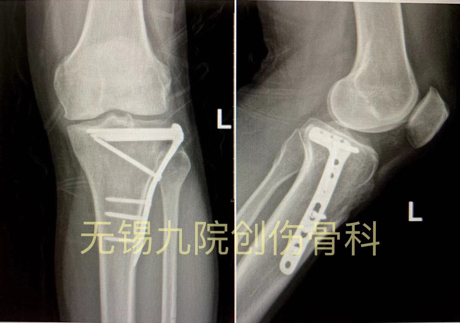 腓骨骨折手术入路图谱图片