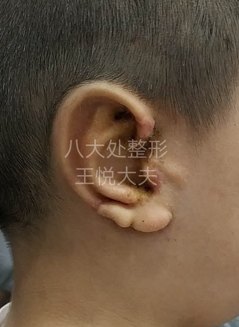 小耳再造手术典型病例照片(持续更新中)