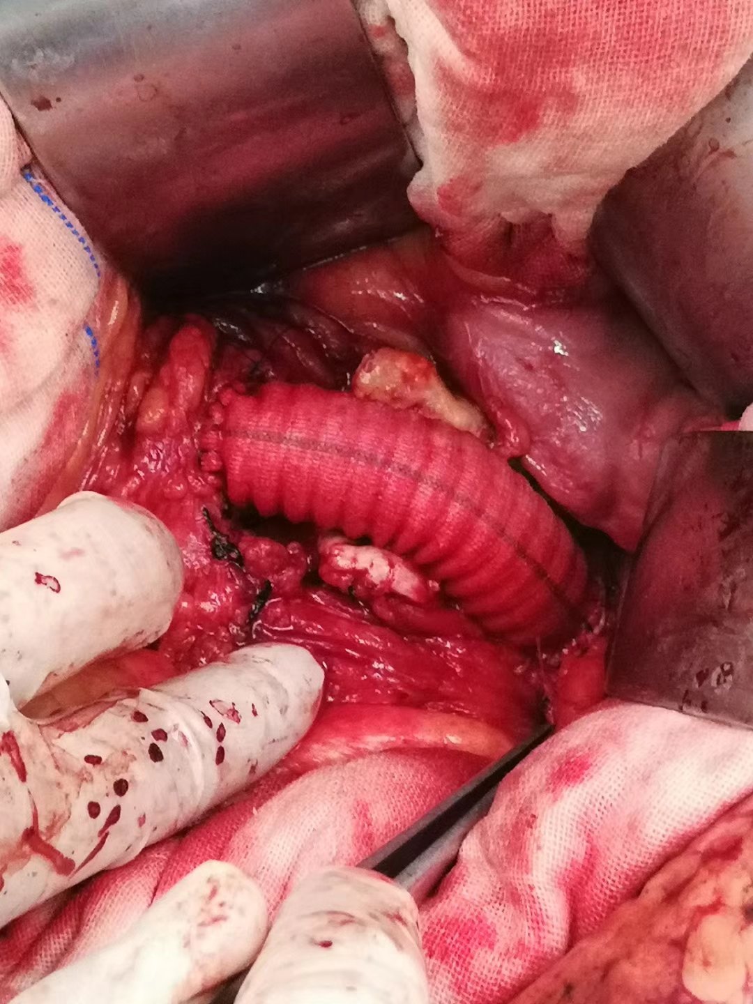 开放手术治疗腹主动脉瘤 - 好大夫在线