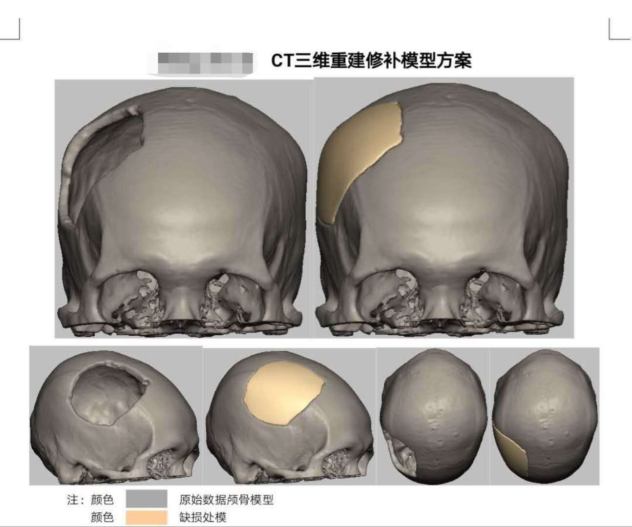 顱骨修補新材料peek給廣大愛美患者帶來福音