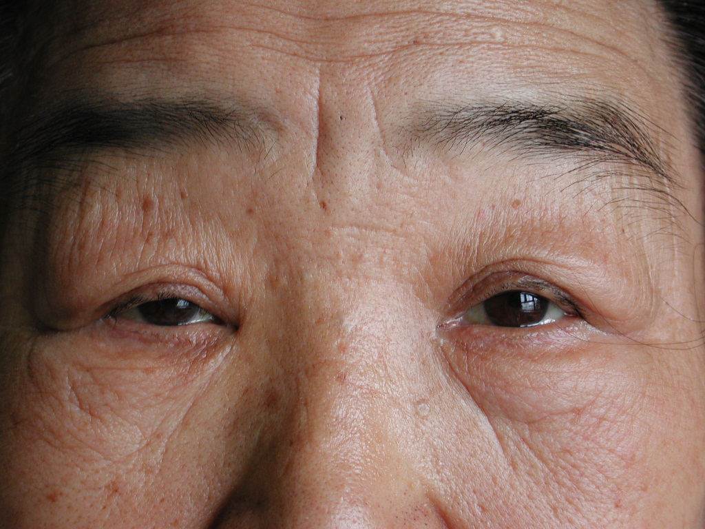 重症肌无力克星—微创胸腺切除 - 好大夫在线