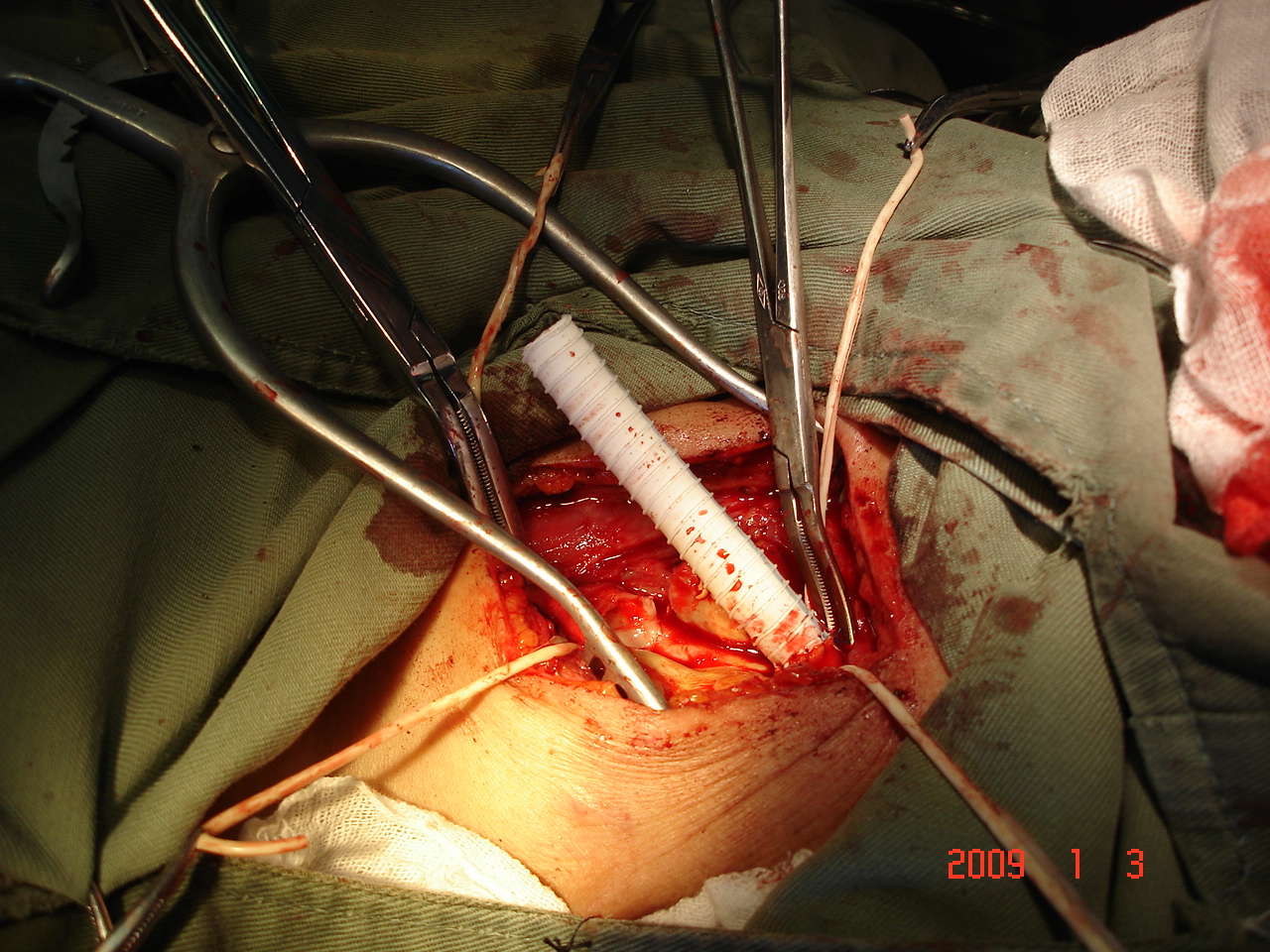赤峰市医院血管外科完成全区首例颈总动脉瘤切除人造血管植入手术