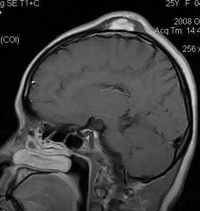 颅骨骨膜窦:术中所见颅骨多发筛孔,可见异常血管团ct表现为颅板外头皮