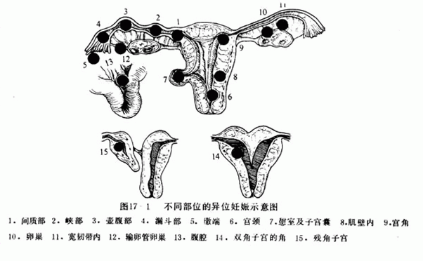 异位妊娠示意图图片