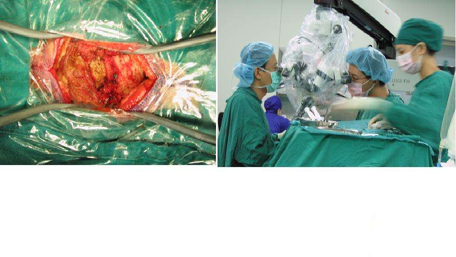 科学认识小脑扁桃体下疝伴脊髓空洞症的治疗及误区 - 好大夫在线