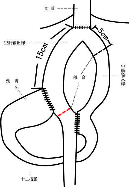 胃底部外生性胃肠道间质瘤---行保留贲门的近端胃切除,环袢式空肠间置