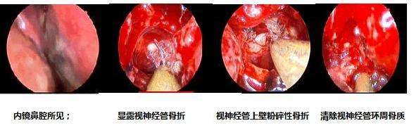 先天性蝶竇腦膜腦膨出一例[j]