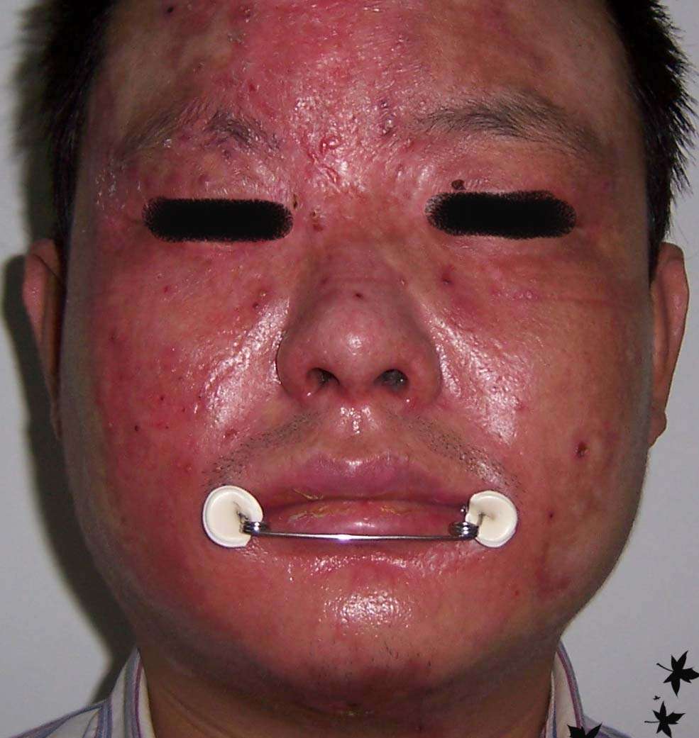 烧伤后口周瘢痕的预防 - 好大夫在线