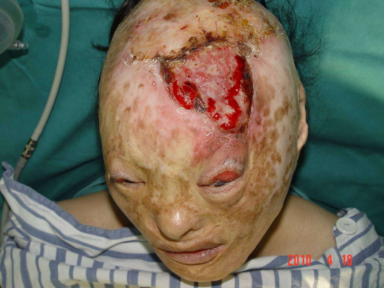 陈旧性烧伤疤痕需防止变异(1) - 好大夫在线