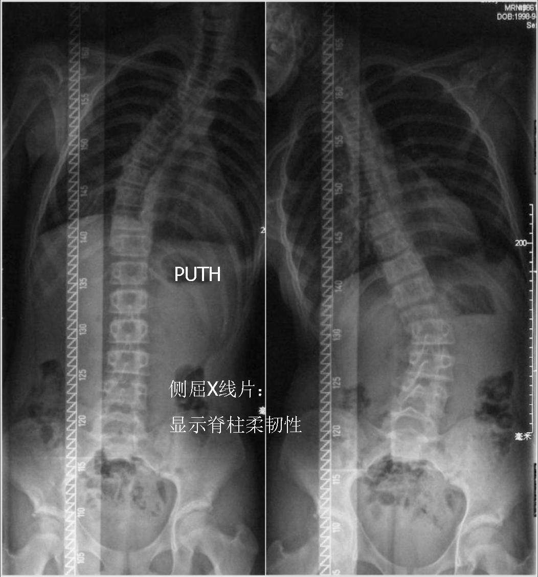 脊柱侧弯11岁女孩cobb角度45度