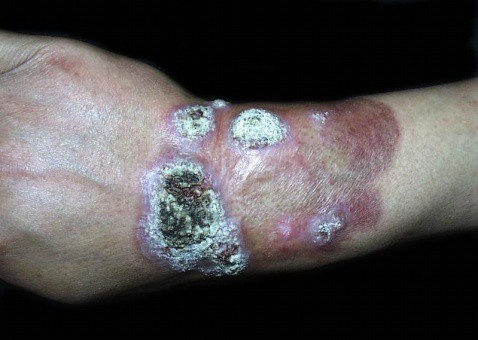 着色芽生菌病_疾病介绍 - 好大夫在线