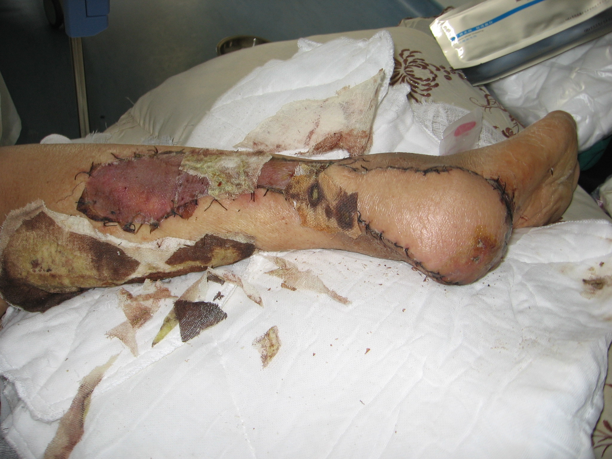 足跟恶性黑色素瘤治疗 - 好大夫在线