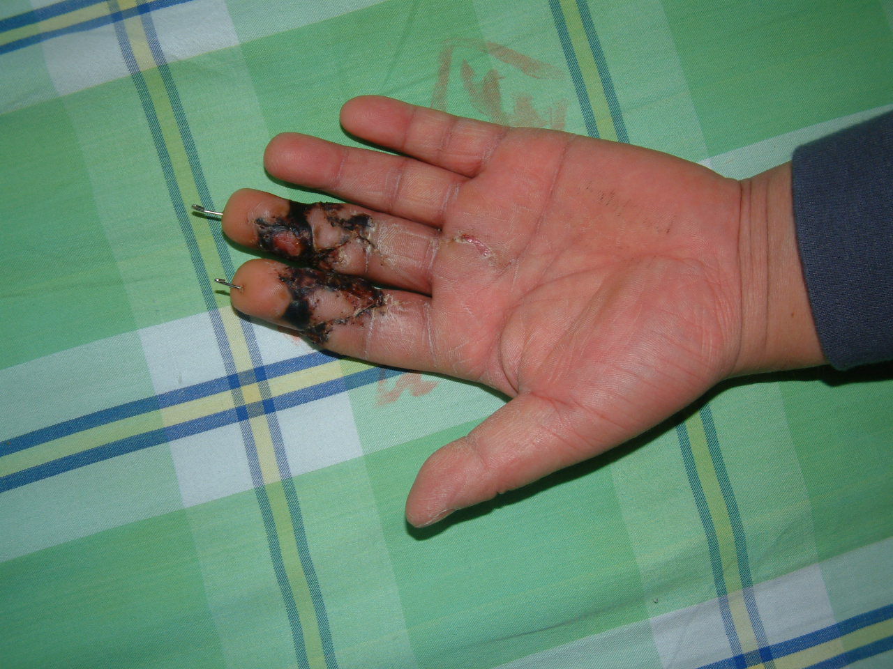 手指再造 - 好大夫在线