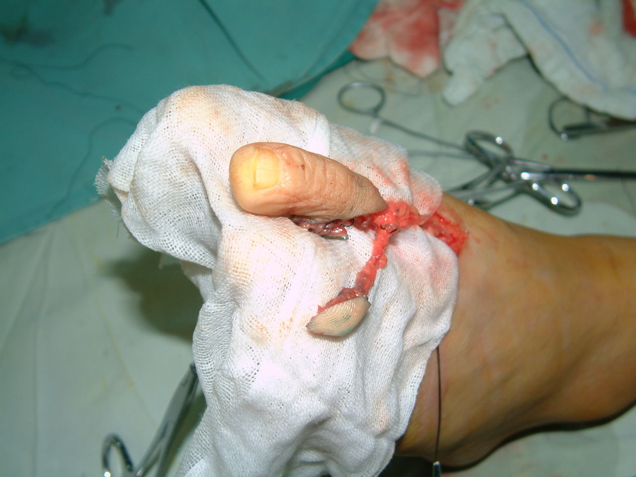 手指再造 - 好大夫在线