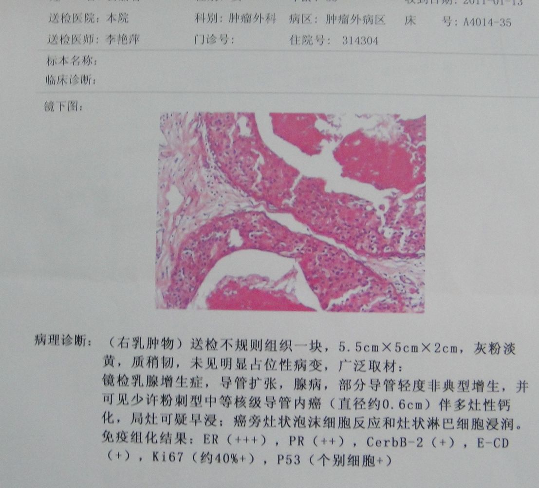 乳腺活检报告图片