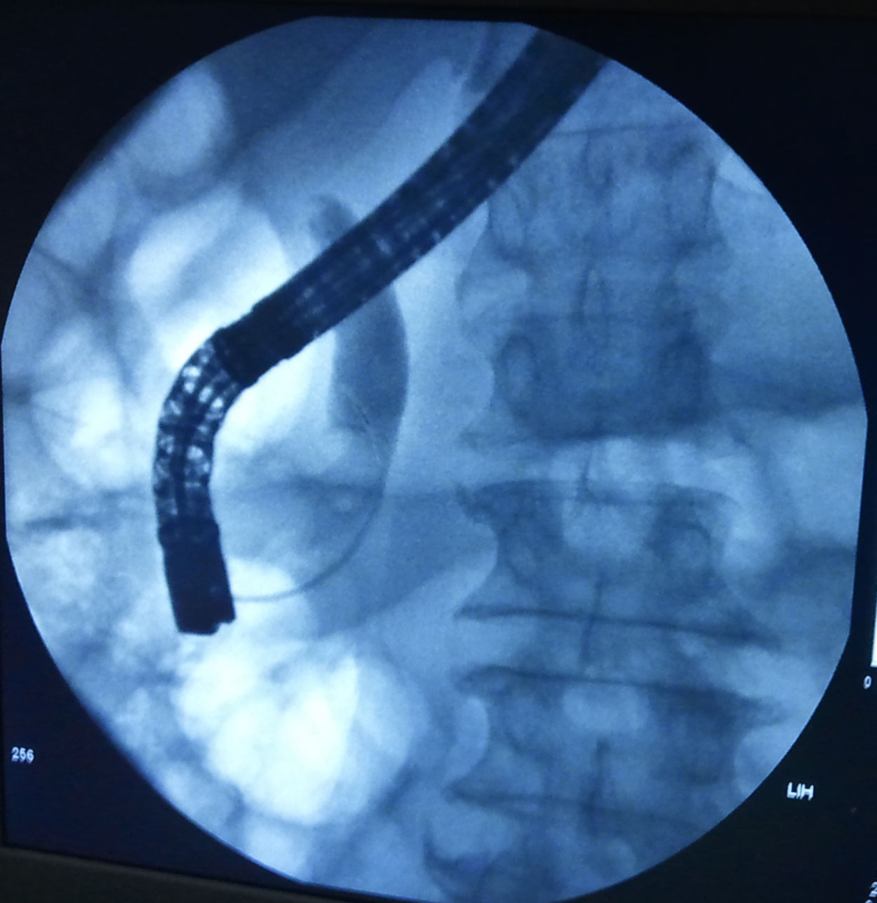 是手术十二指肠乳头插管成功后,胆管内造影,可见胆管下段(白色影)结石