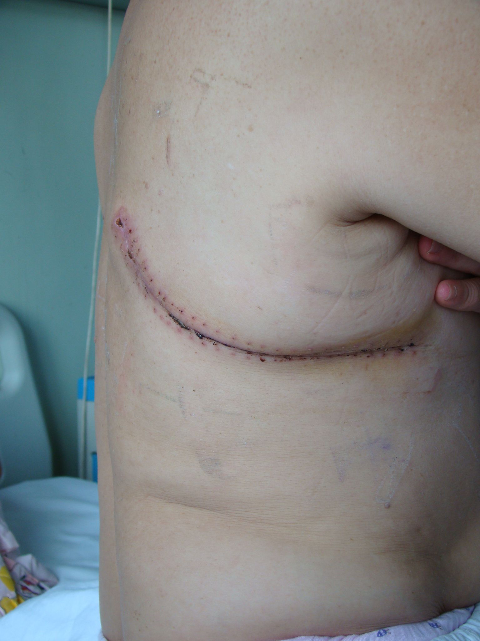 胸口手术的伤口图片图片