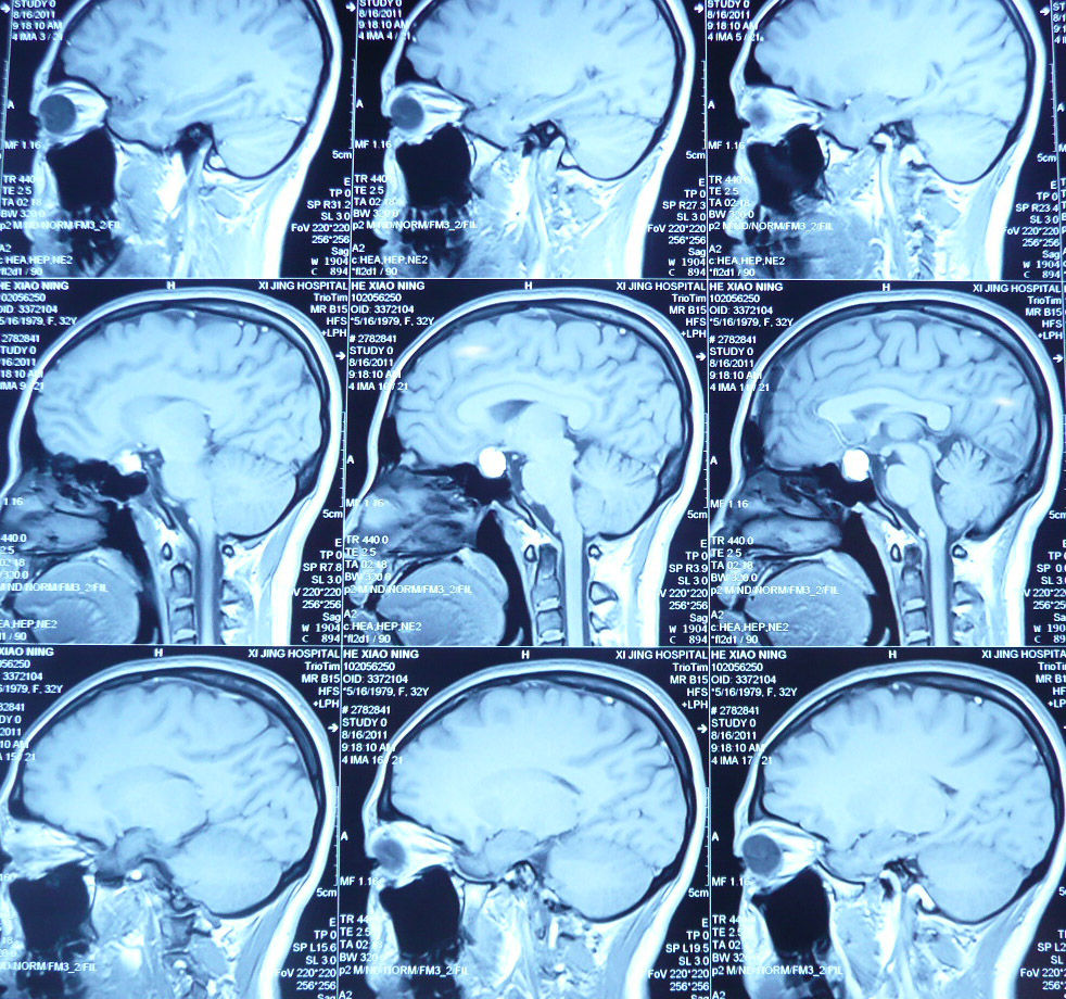 西京医院鞍区囊肿的手术治疗(实例) - 好大夫在线