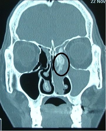 鼻内翻性乳头状瘤图片