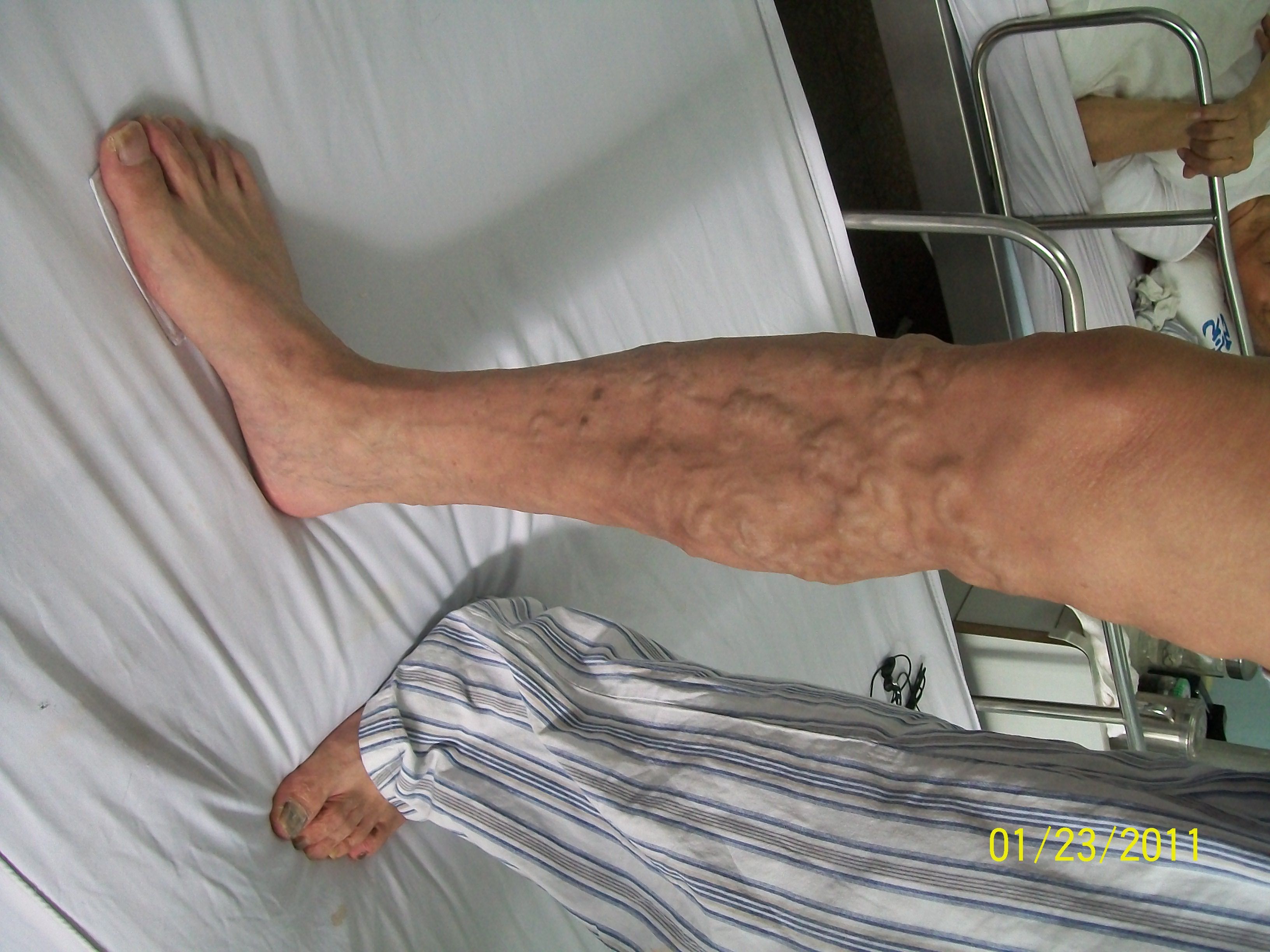 静脉曲张下肢静脉瓣膜功能不全典型一例 - 好大夫在线