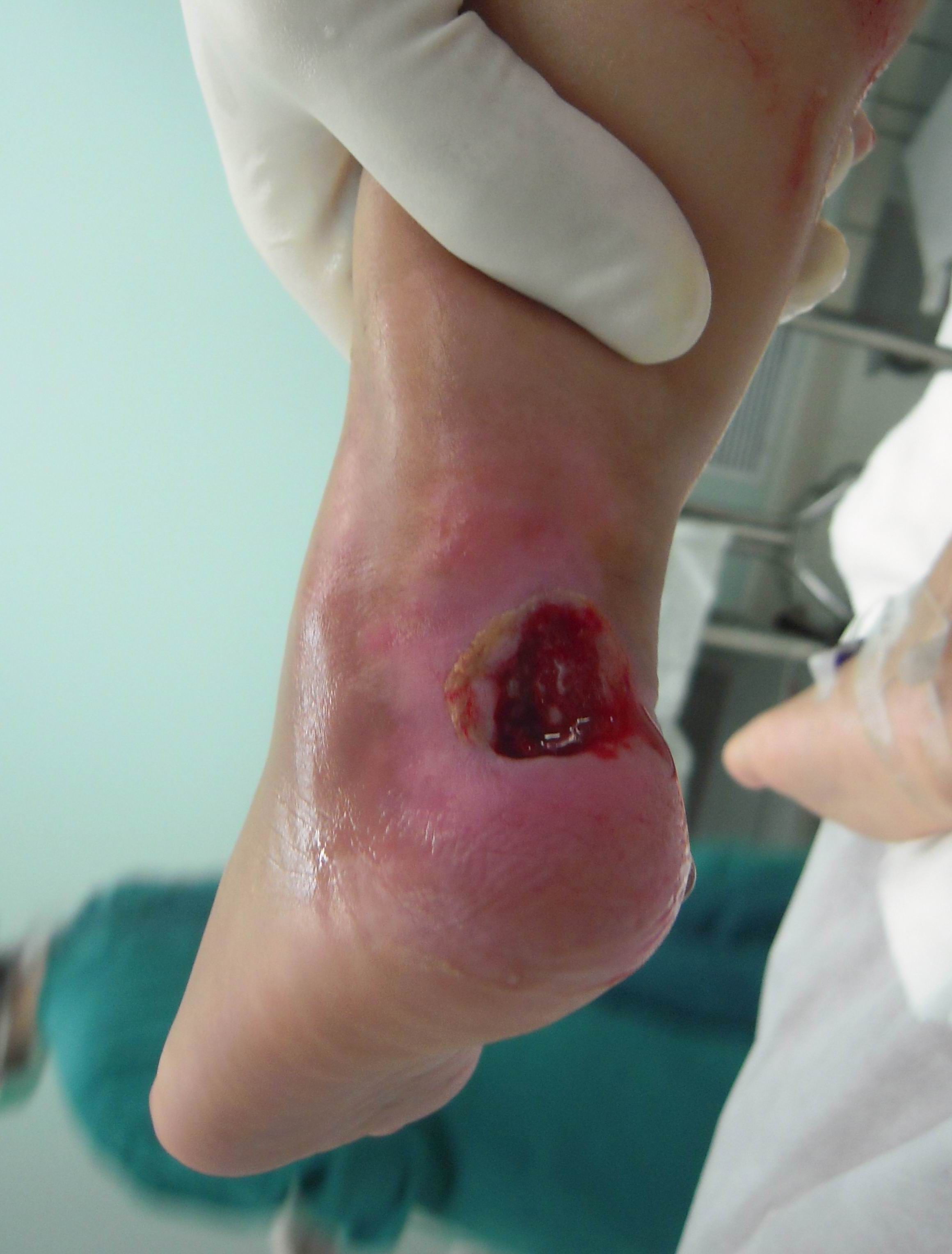 皮瓣设计患儿,男,7岁,也是车祸伤导致足底跟部瘢痕溃疡,行走障碍.