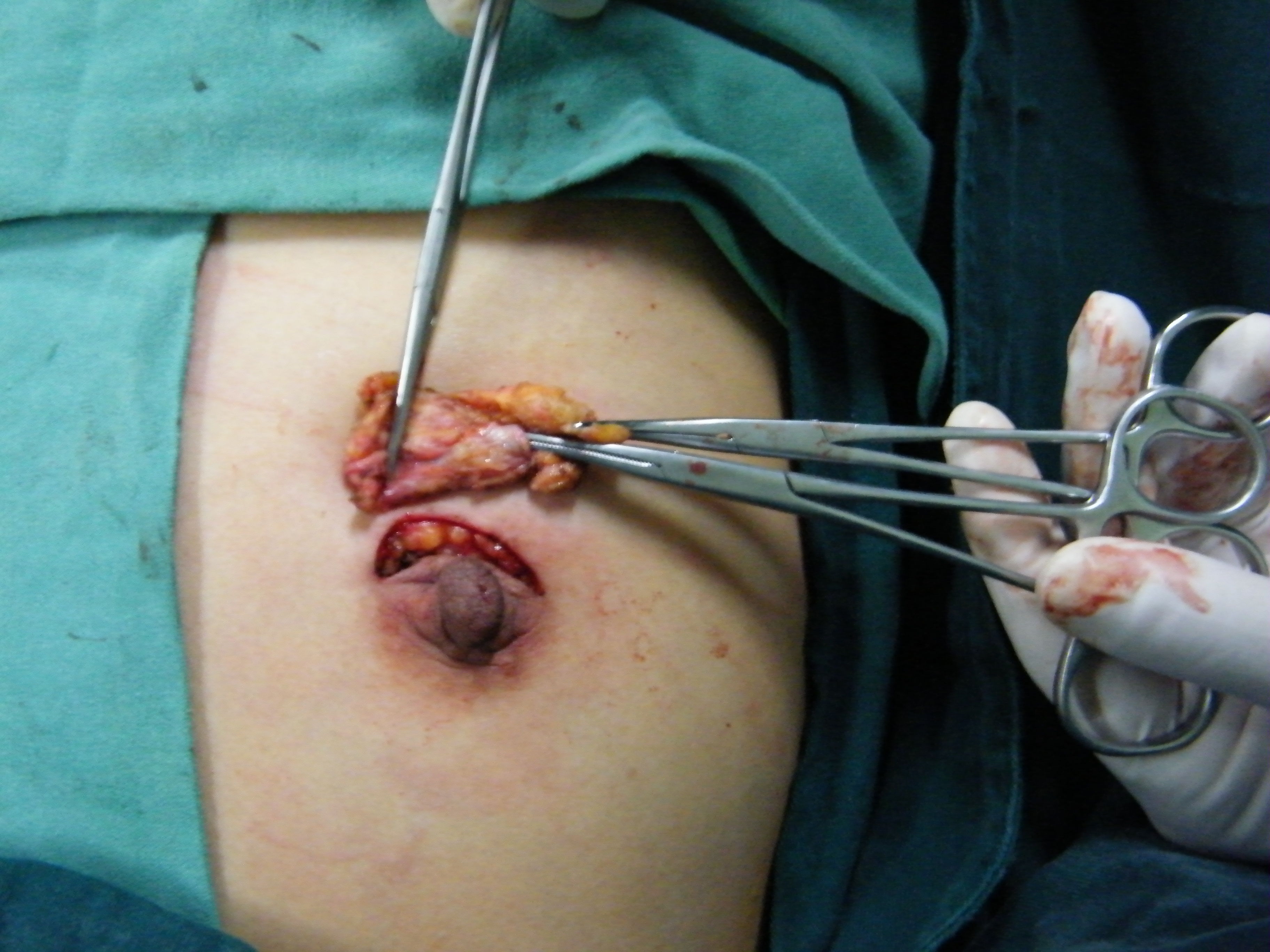 乳腺纤维瘤图片伤口图片