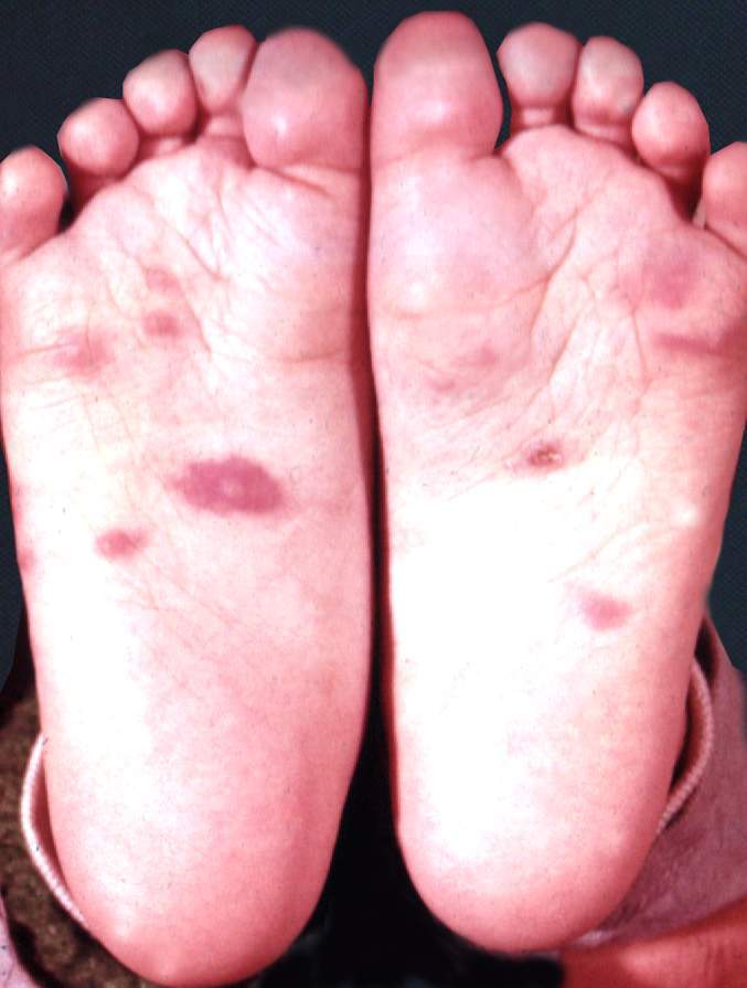 常见儿童皮肤病简介及注意事项 - 好大夫在线