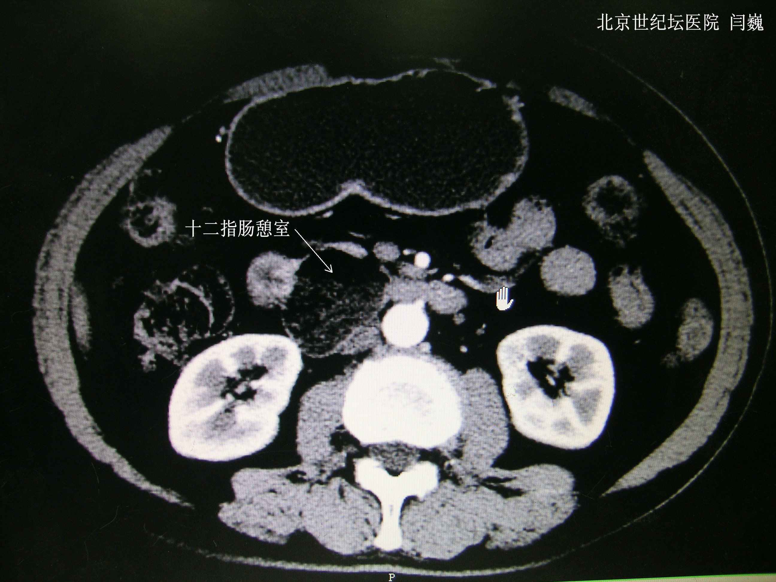 十二指肠憩室CT图片