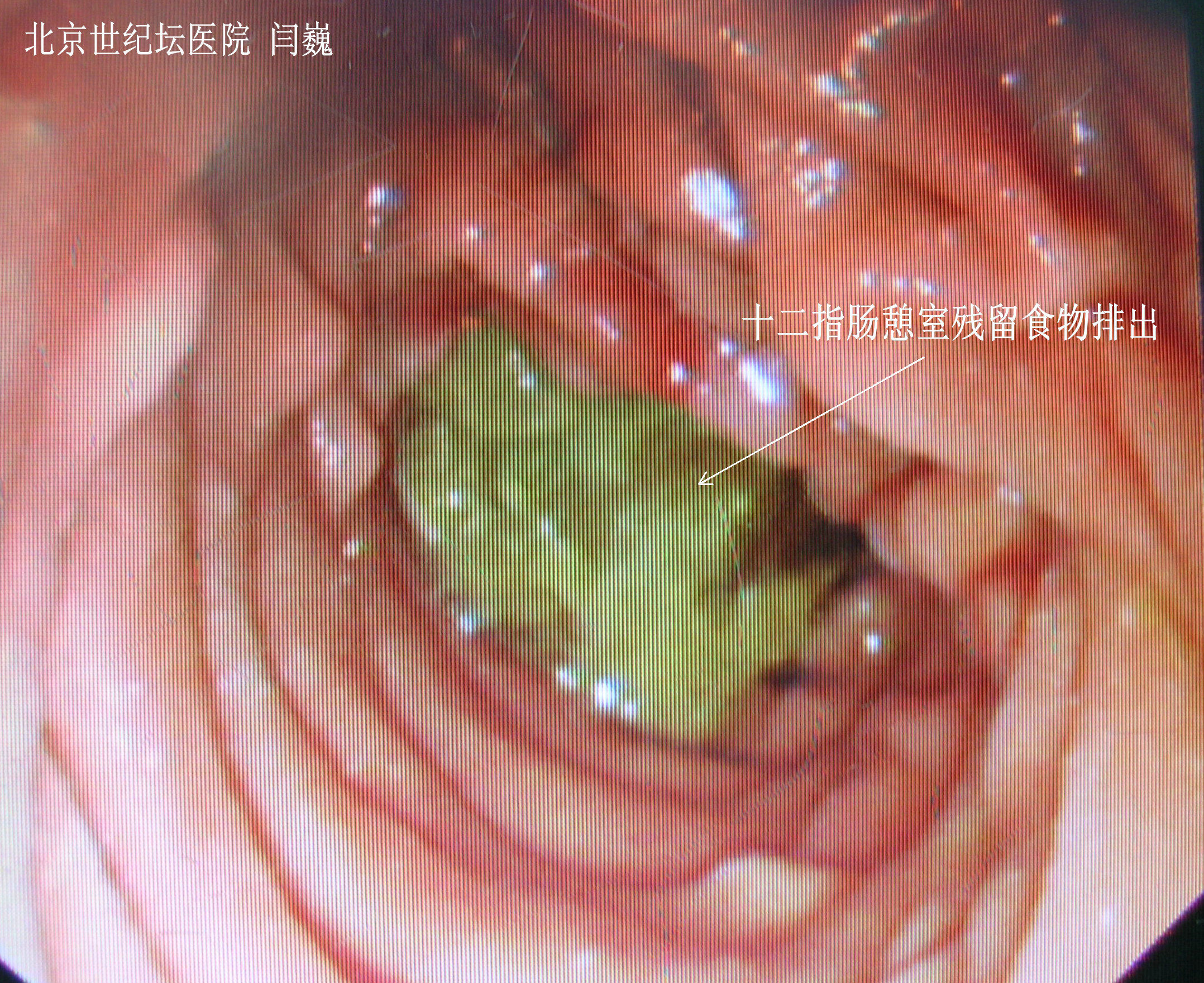 4,空腸造瘻術作為附加手術在患者術後恢復中起到了非常重要的作用