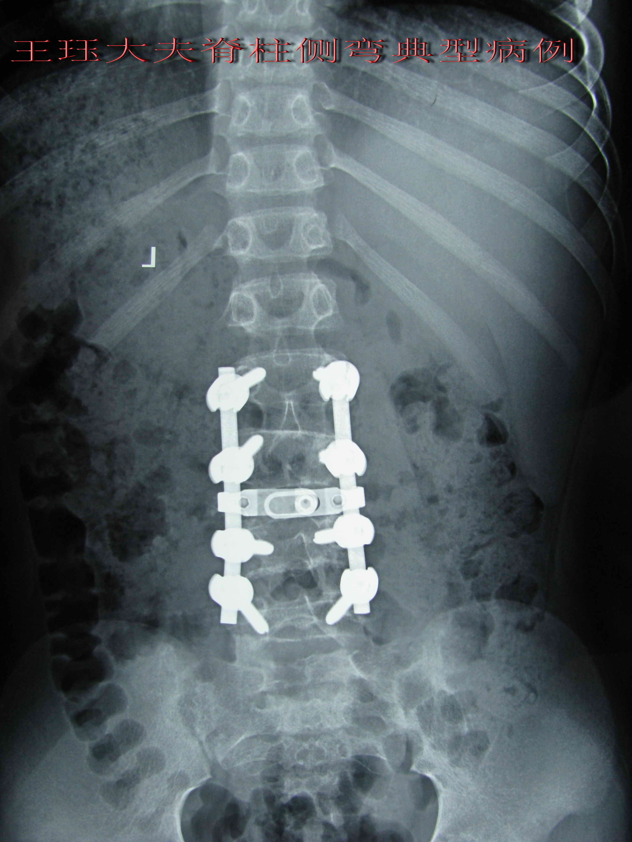 患者:男,11岁,先天性脊柱侧弯