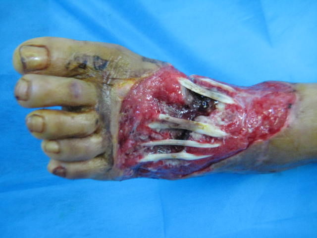 左足重物砸伤皮肤坏死皮瓣修复 - 好大夫在线