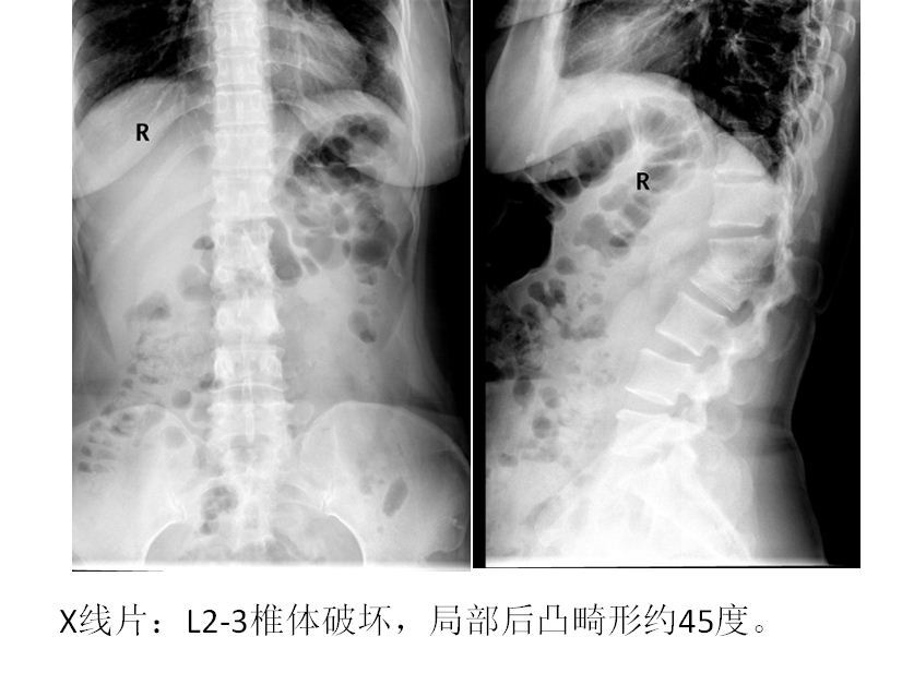 脊柱结核病例25:一例陈旧性脊柱结核伴后凸畸形的治疗 - 好大夫在线