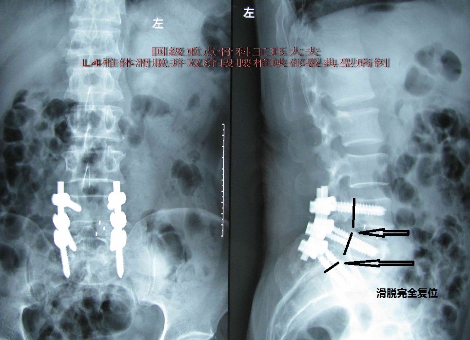 病例4一例特殊腰椎滑脫病例雙椎體峽部裂完全復位解除病痛