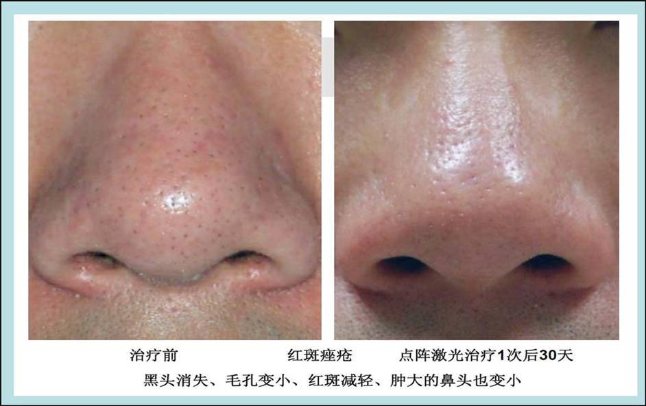 酒糟鼻(鼻赘),妊娠纹,黑鼻头毛孔粗大,植皮后色素沉着,睑黄瘤,汗管瘤.