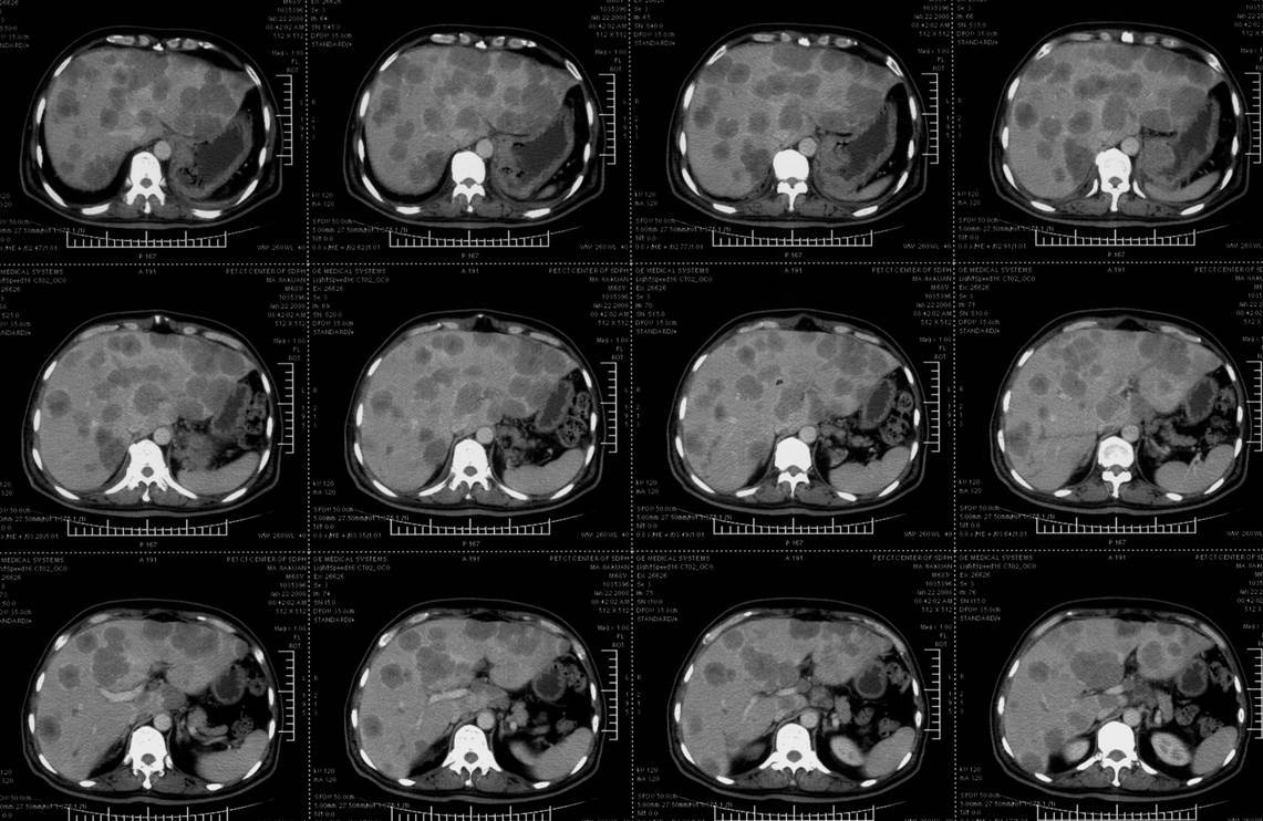 肝转移瘤介入治疗 - 好大夫在线