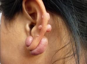 耳洞瘢痕疙瘩照片图片