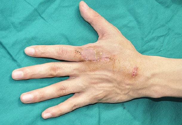 伸肌腱粘连松解术 - 好大夫在线